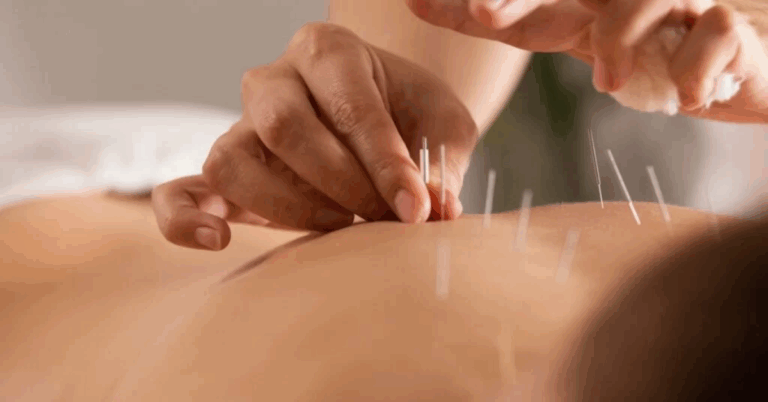 Acupuncture Singapore: Natural Healing Through Traditional Chinese Medicine