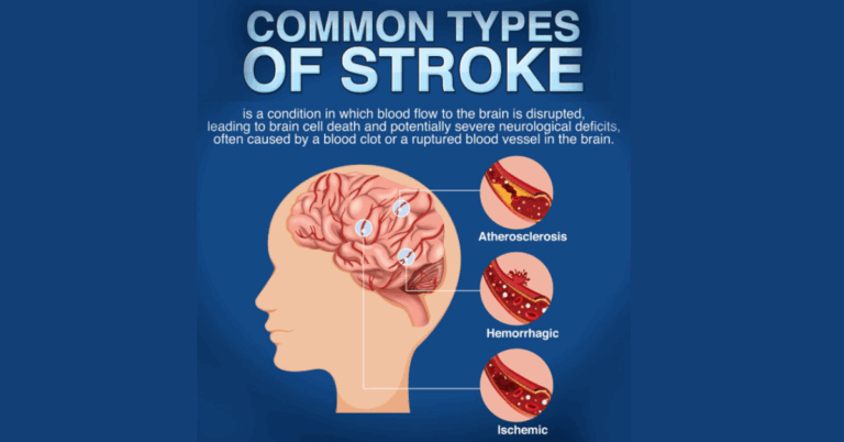 TMS for Stroke: A Revolutionary Approach to Post-Stroke Recovery